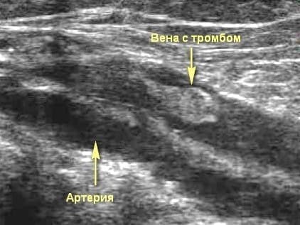 Тромбоз глубоких вен